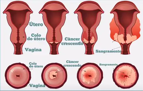 O papanicolau deve ser feito uma vez por ano, quando não há sinal da doença.