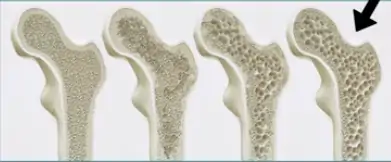 O enfraquecimento do osso é a osteoporose.