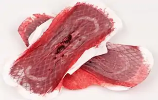 Perda de sangue também causa a doença