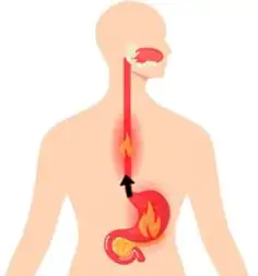 A gastrite pode causar dor na barriga na parte de cima