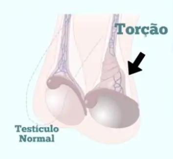 O testículo gira no seu próprio eixo, torcendo o cordão de vasos que o nutre.