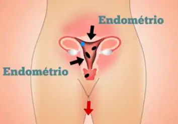 Se não há gravidez, o endométrio se solta do útero causando sangramento .