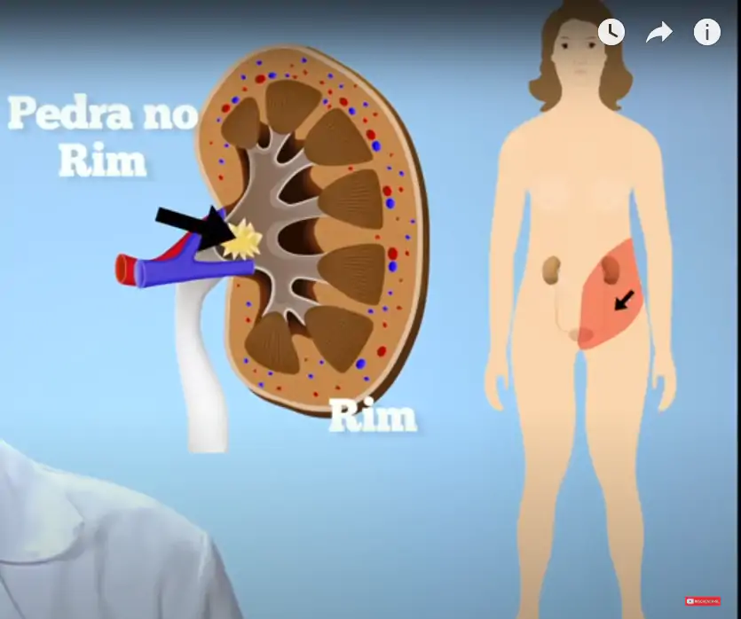 As pedras nos rins também podem causar sintomas que fazem as costas doerem.