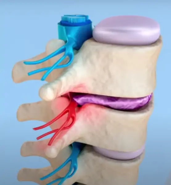 A dor em 90% das vezes é lombalgia mecânica.