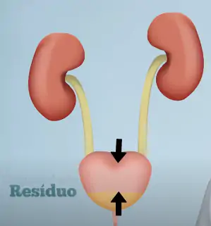 O resíduo causa sensação de esvaziamento incompleto de bexiga.