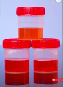 Causas de sangue na urina