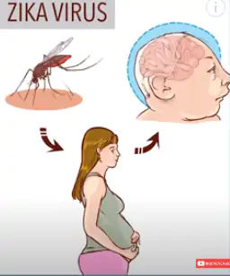 Se a gestante for contaminada com o zika vírus, aumenta o risco de a criança nascer com microcefalia