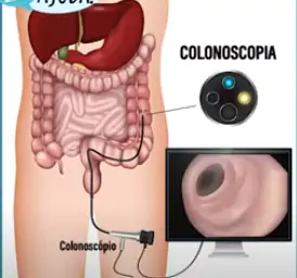 A colonoscopia, que avalia o reto e todo intestino grosso.