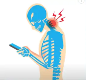 Pessoas que passam muito tempo olhando o celular, inclinando a cabeça para baixo.