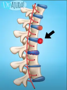 As estruturas que compõem a coluna também sofrem um desgaste e estão ligadas à causas de torcicolo.