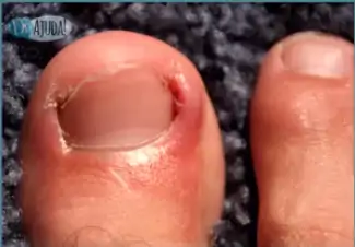 A unha encravada ocorre quando a lateral da unha machuca a pele.