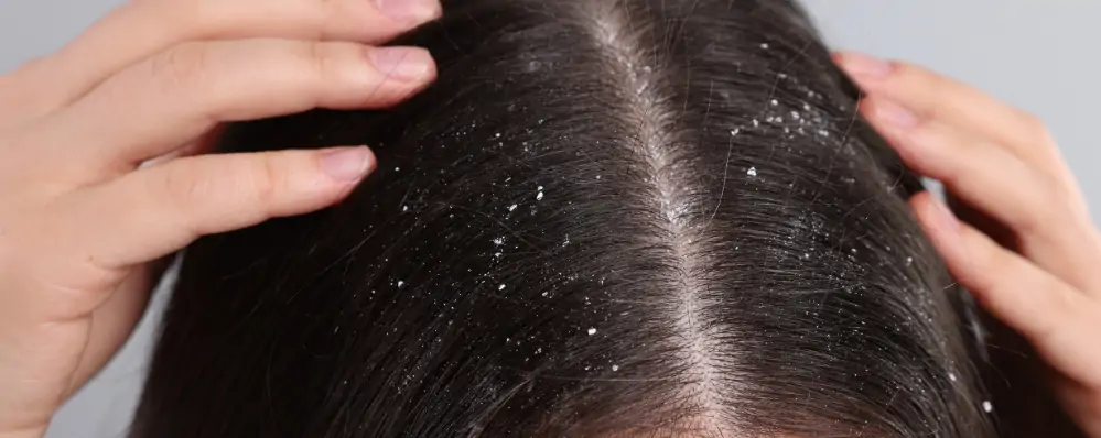Dermatite seborreica e caspa quais sao as causas e o que fazer