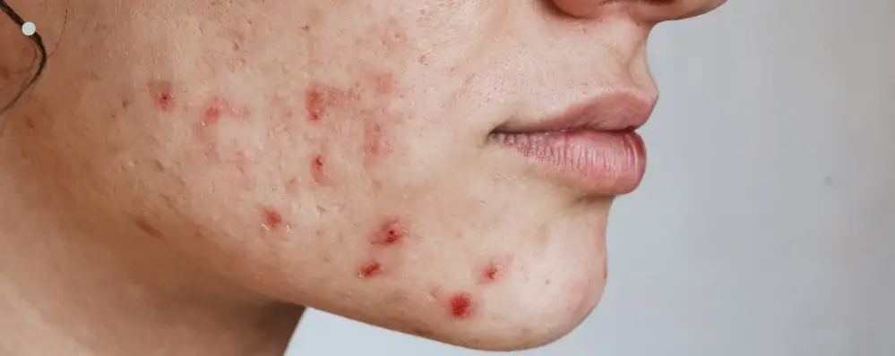 acne