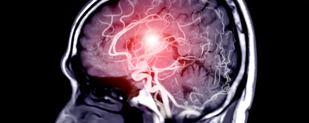 aneurisma cerebral