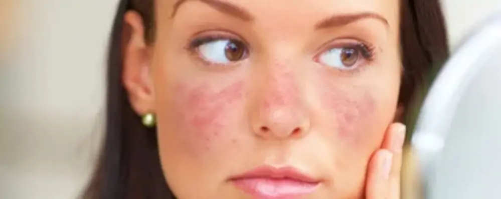 lupus
