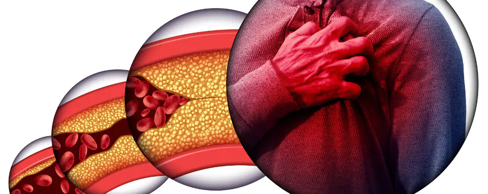 Aterosclerose o que e causas sintomas fatores de risco tratamento e prevencao